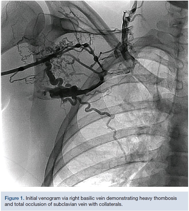 Acute Occlusion of Right Axillary to Left Jugular Collateral Vein
